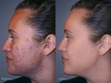 Skinelle cream effectively controls acne, pimples and keeps the skin healthy 20g
