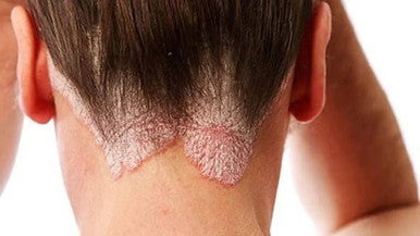 Natural Ringworm and Psoriasis Anti-itch Ointment