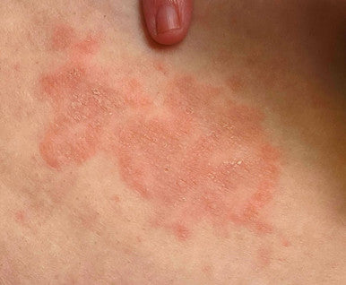 Natural Ringworm and Psoriasis Anti-itch Ointment