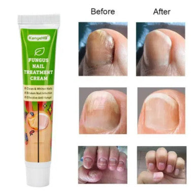 Fungus Nail Treatment Cream - 20g