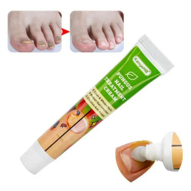 Fungus Nail Treatment Cream - 20g