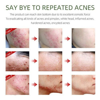herbal acne removing cream 50g anti inflammation