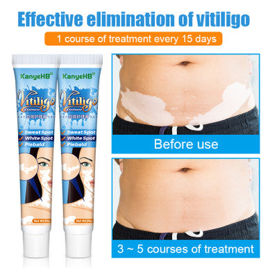 Vitiligo Ointment Psoriasis Mycosis Leukoplakia Antibacterial Anti-itch Relief Pain Treatment Cream 20g