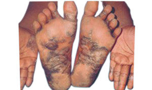 Psorolin oil 200ml controls enzymes that worsen psoriasis