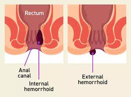 Constipation & Bleeding Piles