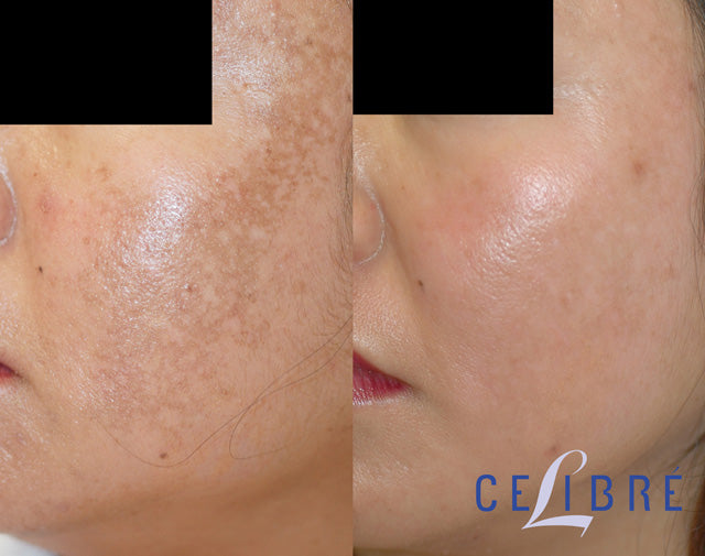Skin lite cream for the short-term moderate to severe melasma on the face 25g