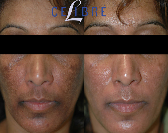 Skin lite cream for the short-term moderate to severe melasma on the face 25g