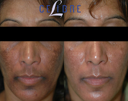 Skin lite cream for the short-term moderate to severe melasma on the face 25g
