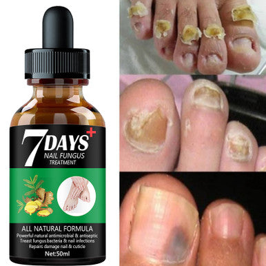 Nail Fungus Treatment Essence Serum Care Hand and Foot Care Removal Repair Gel Anti-infective  10 ml