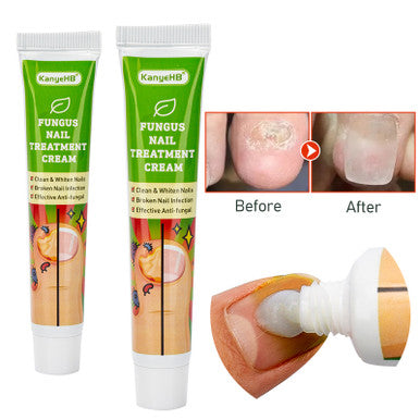 Nail Fungal Treatment Ointment Anti Infection Paronychia Onychomycosis Foot Toe Nail Fungus Removal Cream Feet Care