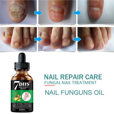 Nail Fungus Treatment Essence Serum Care Hand and Foot Care Removal Repair Gel Anti-infective  10 ml