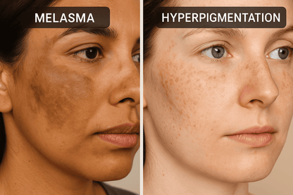 Skin lite cream for the short-term moderate to severe melasma on the face 25g