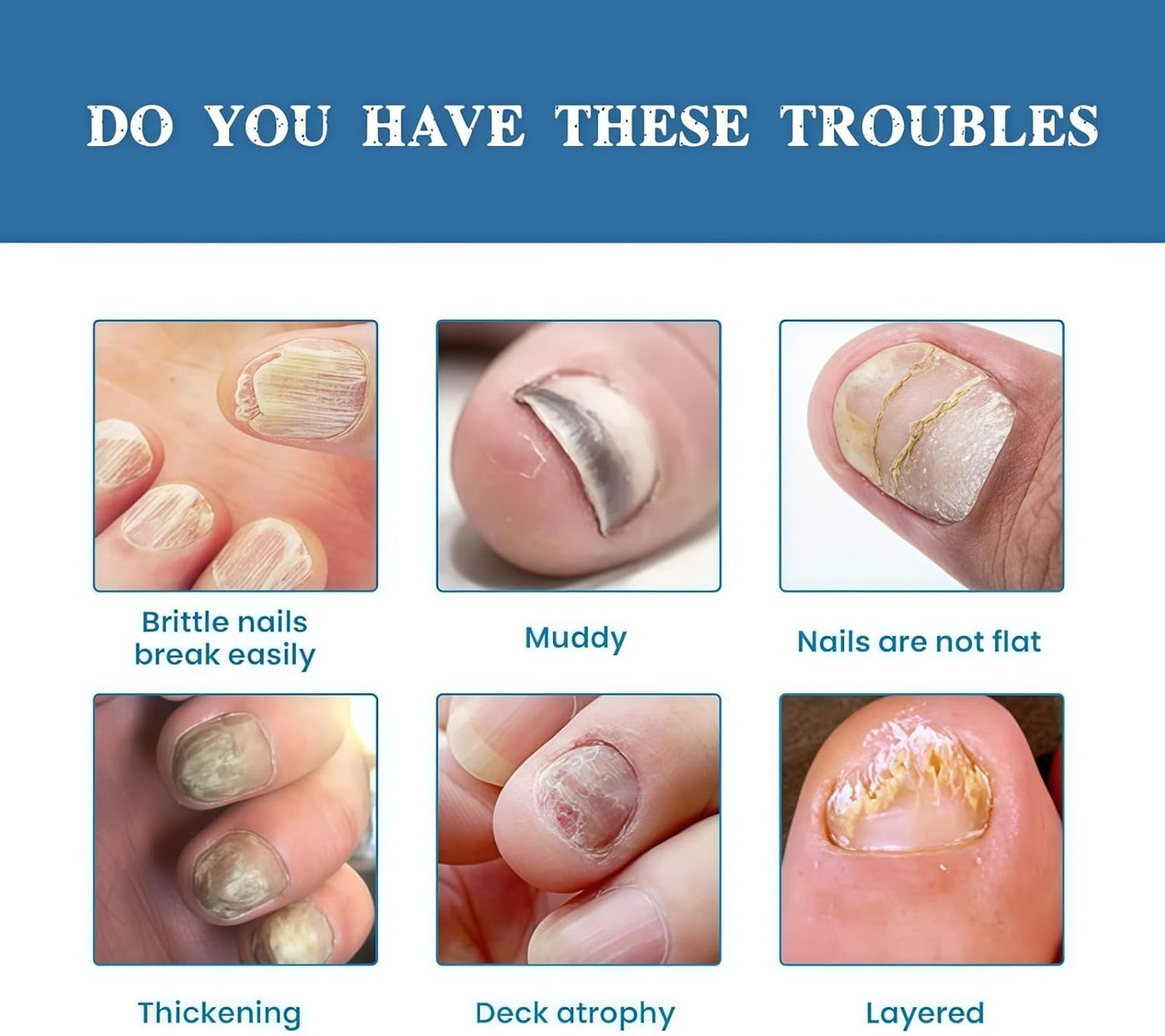 Nail Fungus, anti fungal Treatment Cream - 20g