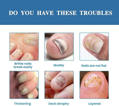 Nail Fungus, anti fungal Treatment Cream - 20g