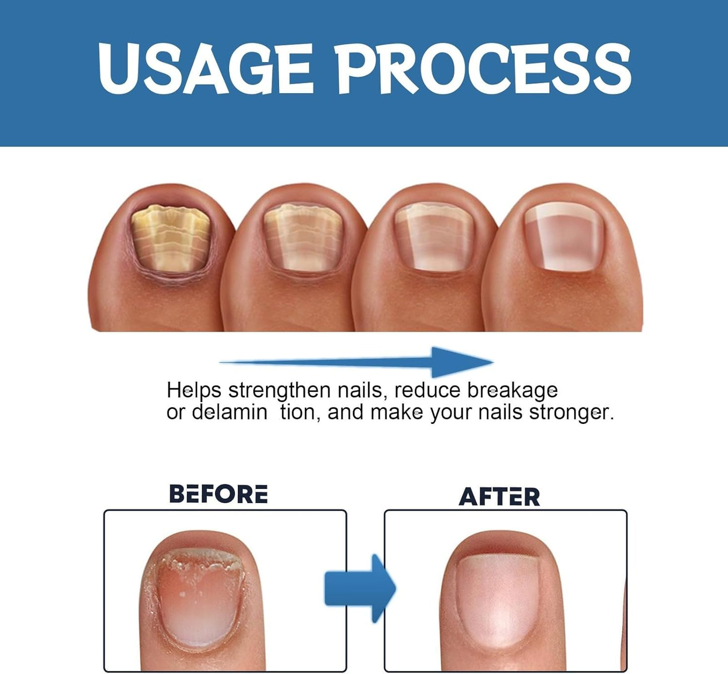 Nail Fungus, anti fungal Treatment Cream - 20g