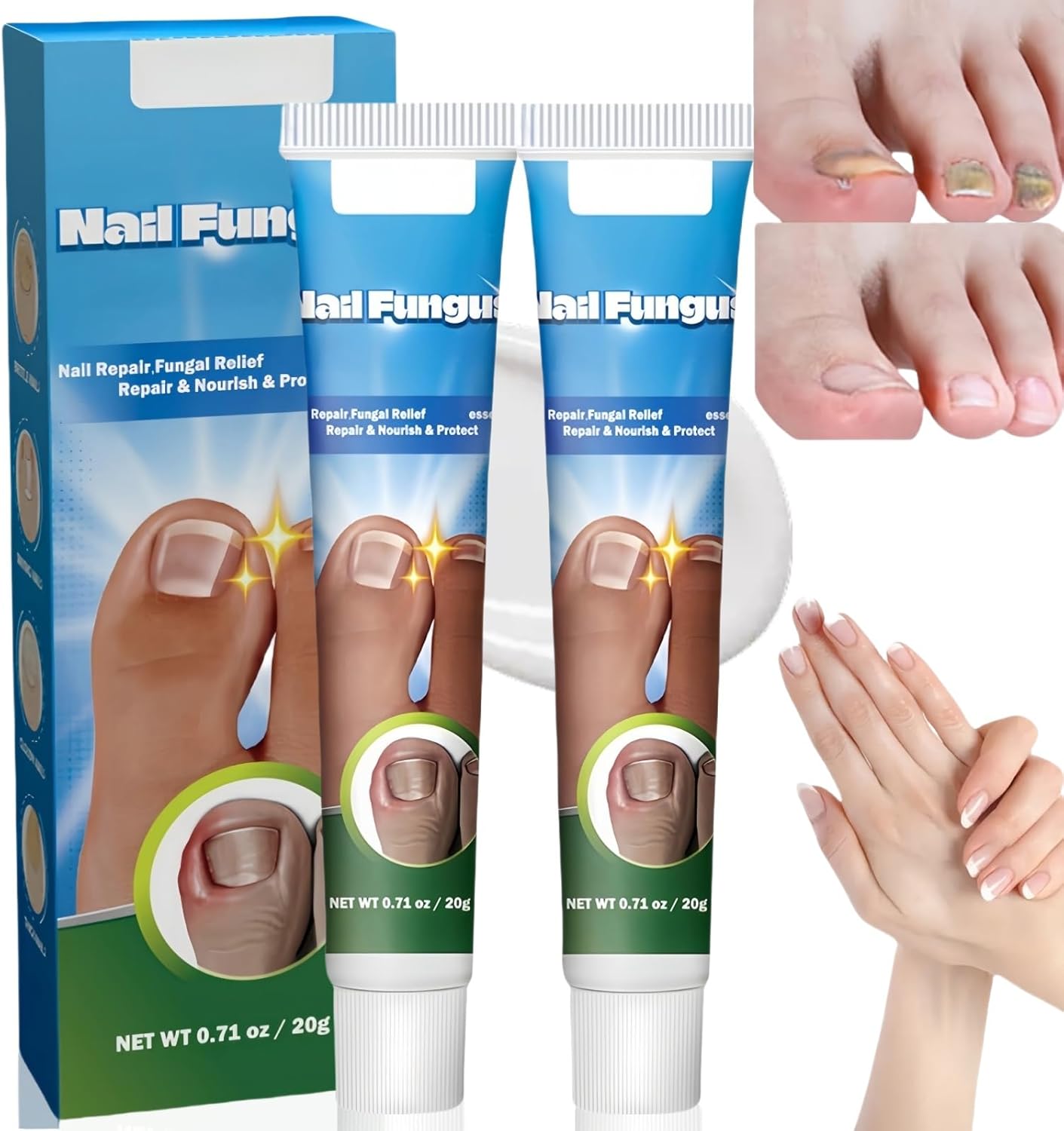 nail fungus cream